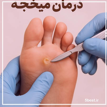 درمان میخچه پا