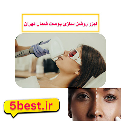 لیزر روشن سازی پوست در شمال تهران