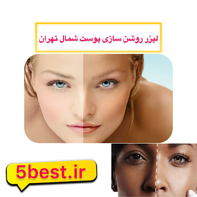 لیزر روشن سازی پوست در شمال تهران