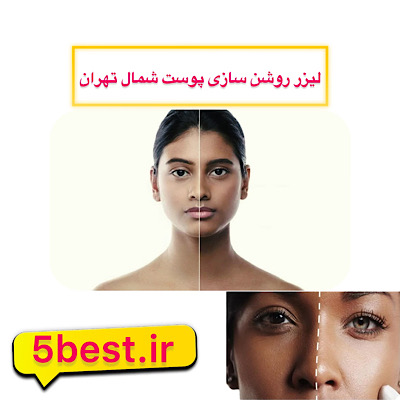 لیزر روشن سازی پوست در شمال تهران