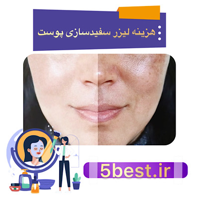 هزینه لیزر سفید سازی پوست