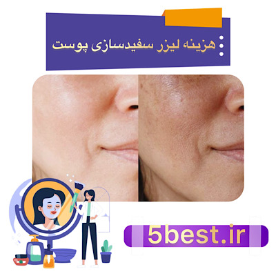 هزینه لیزر سفید سازی پوست