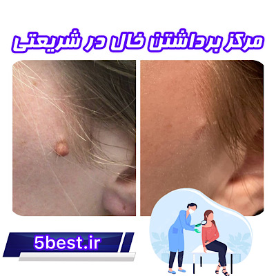 مرکز برداشتن خال در شریعتی تهران