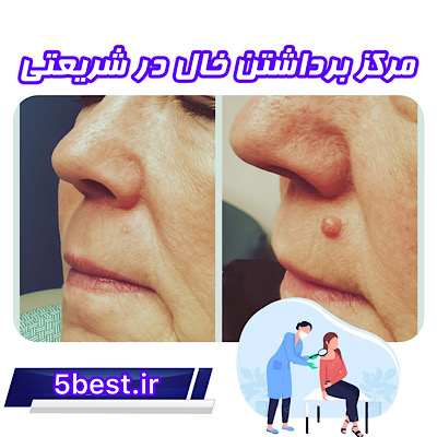 مرکز برداشتن خال در شریعتی تهران