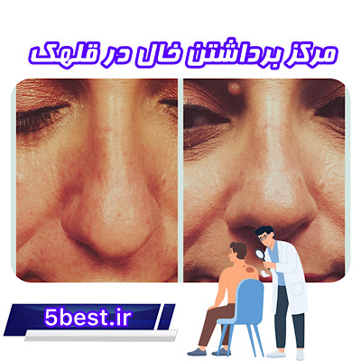 مرکز برداشتن خال در قلهک
