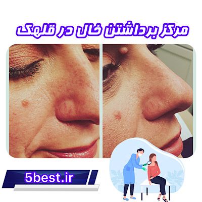 مرکز برداشتن خال در قلهک