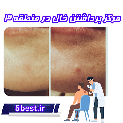برداشتن خال در منطقه3