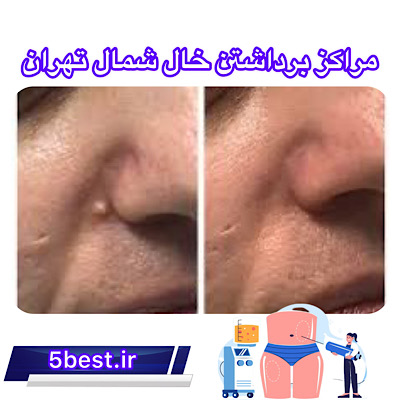 مراکز خال برداری در شمال تهران