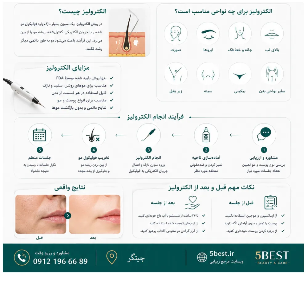 الکترولیز مو زائد