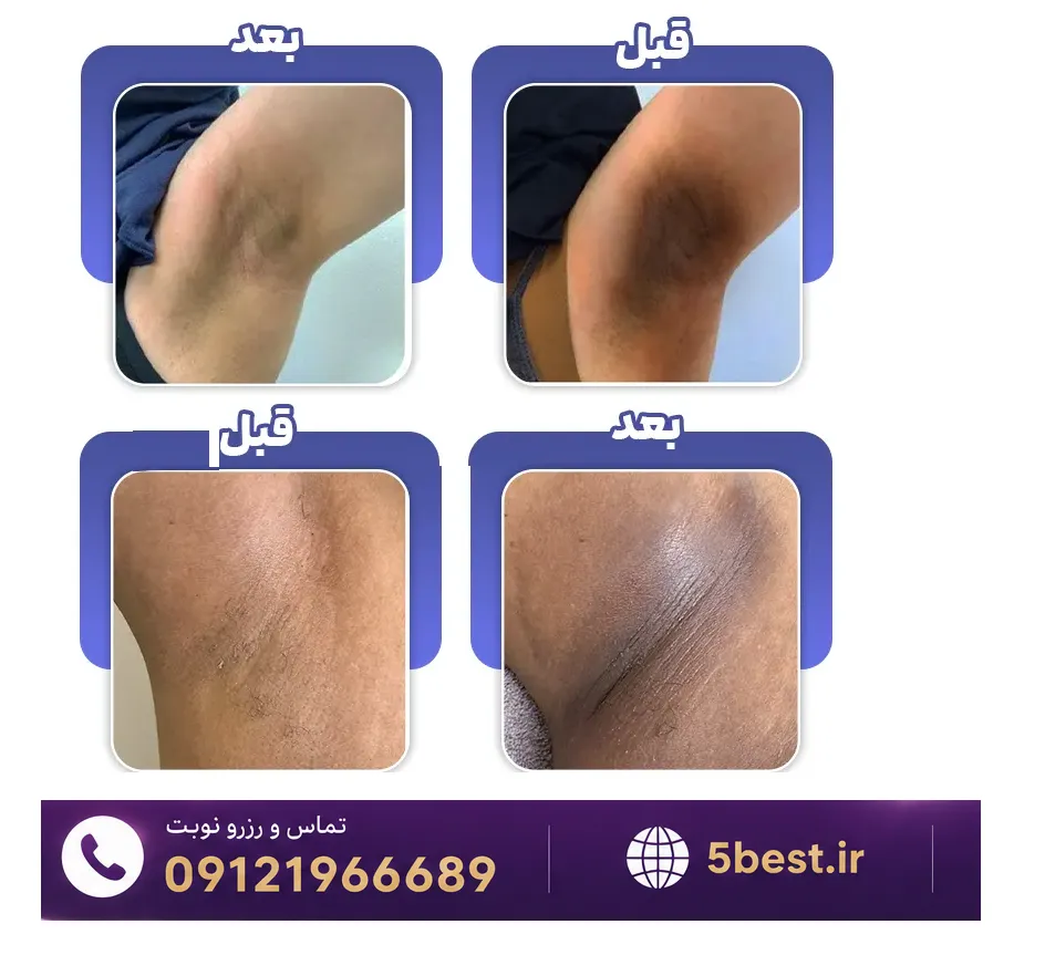 عکس لیزر روشن کننده