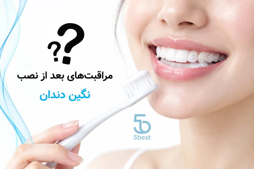 کاشت نگین دندان در شمال تهران مراقبت‌های بعد از نصب