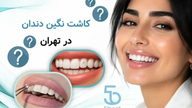 کاشت نگین دندان در تهران