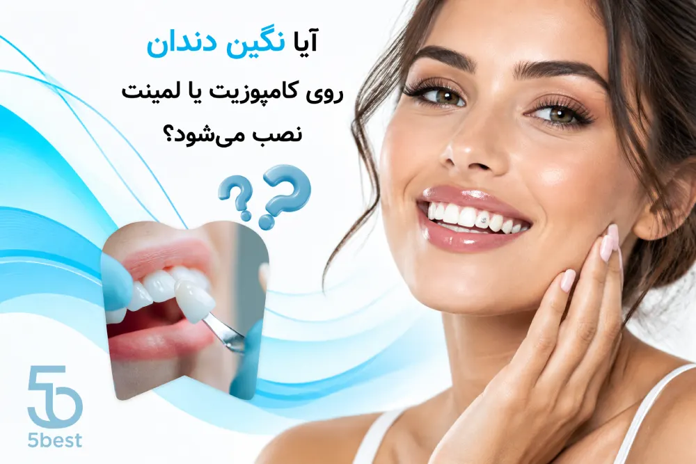 کاشت نگین دندان در شمال تهران آیا نگین دندان روی کامپوزیت یا لمینت نصب می‌شود؟