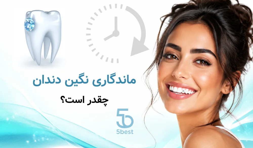 ماندگاری نگین دندان چقدر است؟